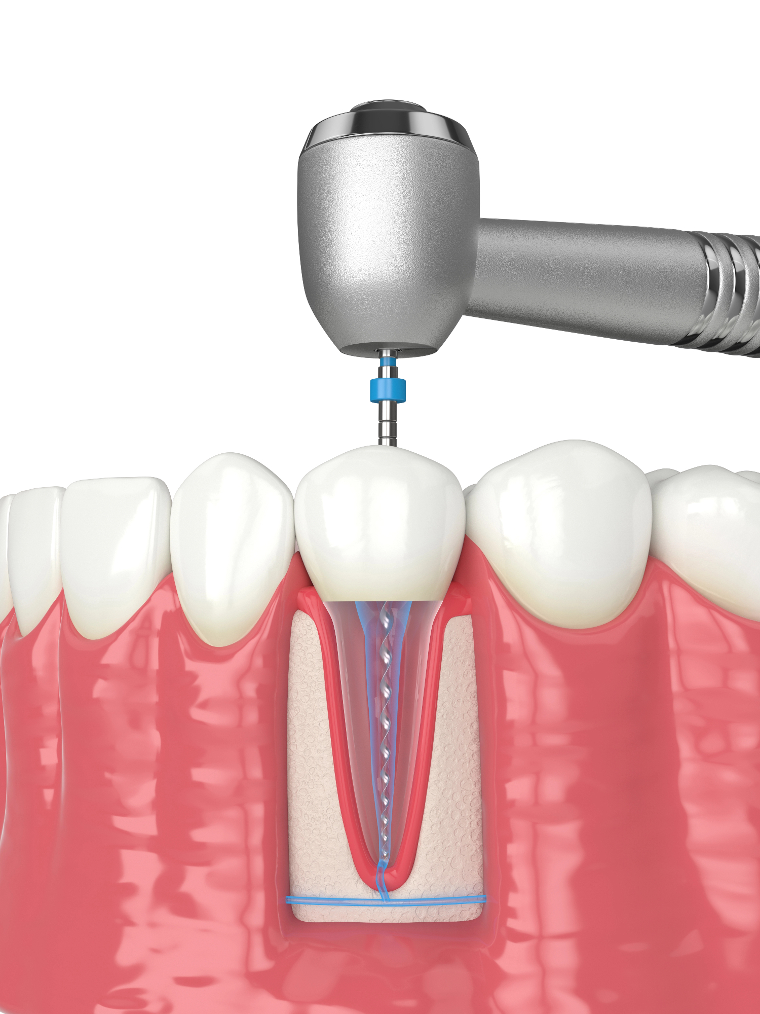 Huda bolečina zoba lahko pomeni to, da je endodontija nekaj kar potrebujemo